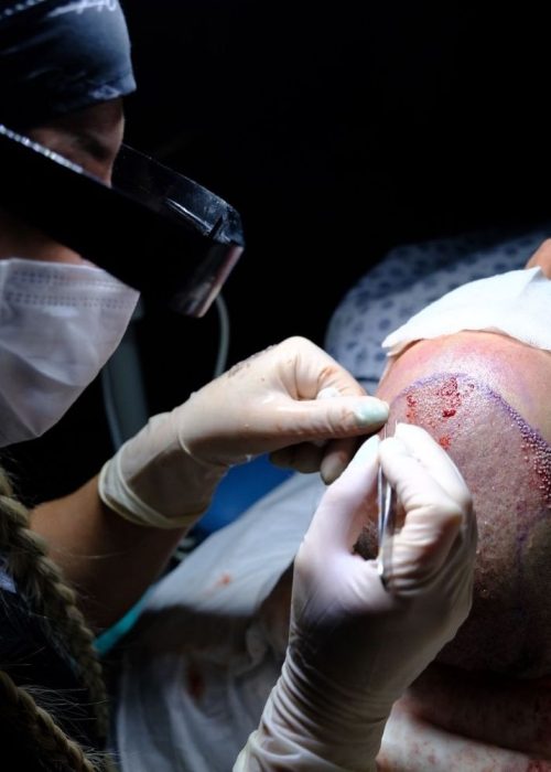 fue-sac-ekimi-wow-hair-clinic