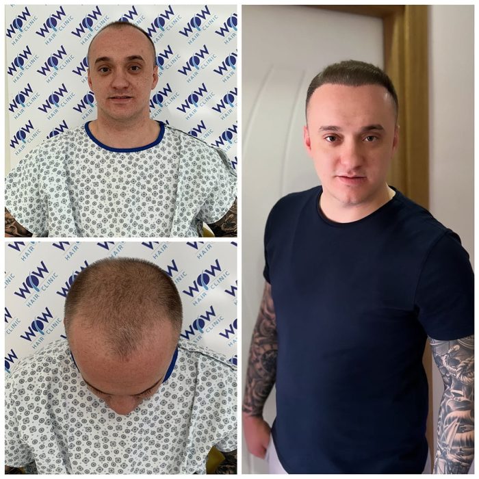 hair-transplant-wow-hair-clinic-antalya-1