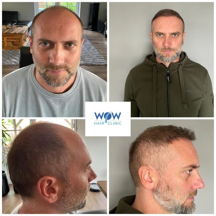 hair-transplant-wow-hair-clinic-antalya-2