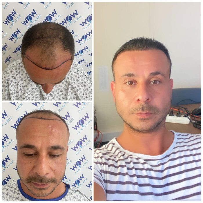 hair-transplant-wow-hair-clinic-antalya-3