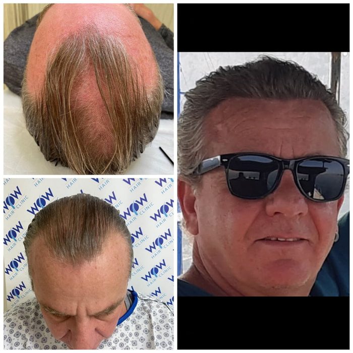 hair-transplant-wow-hair-clinic-antalya-4