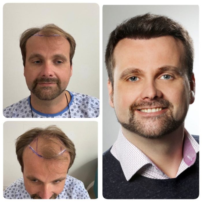 hair-transplant-wow-hair-clinic-antalya-5