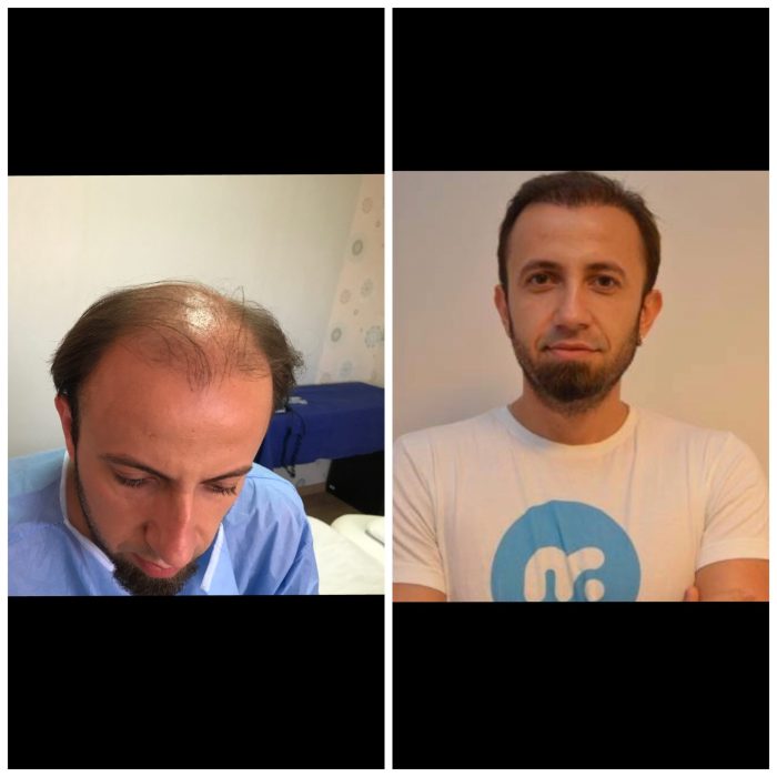 hair-transplant-wow-hair-clinic-antalya-6