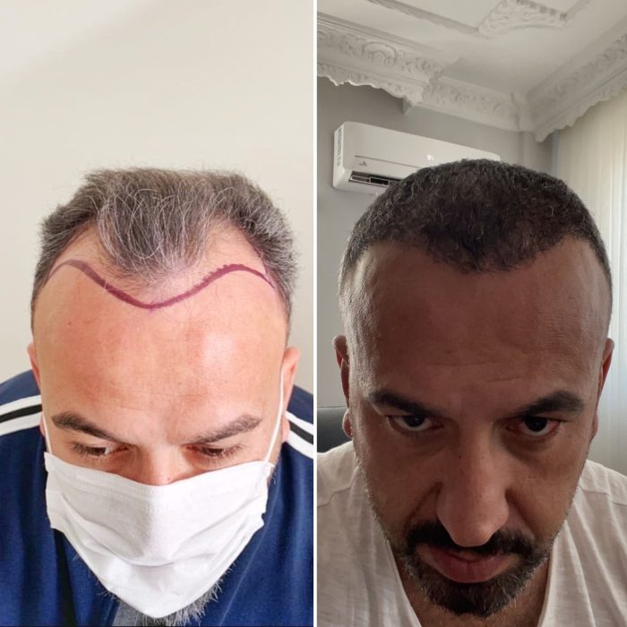 hair-transplant-wow-hair-clinic-antalya-7