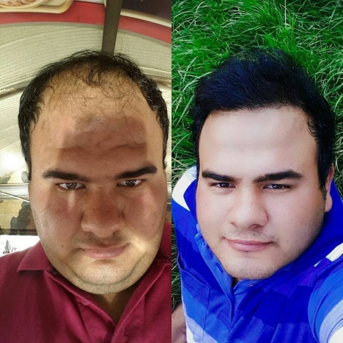 hair-transplant-wow-hair-clinic-antalya-8