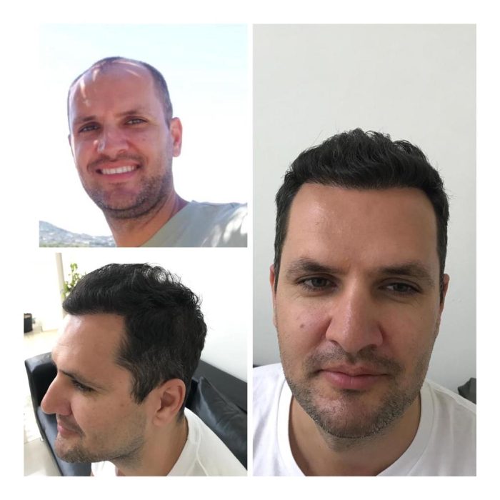 hair-transplant-wow-hair-clinic-antalya-9