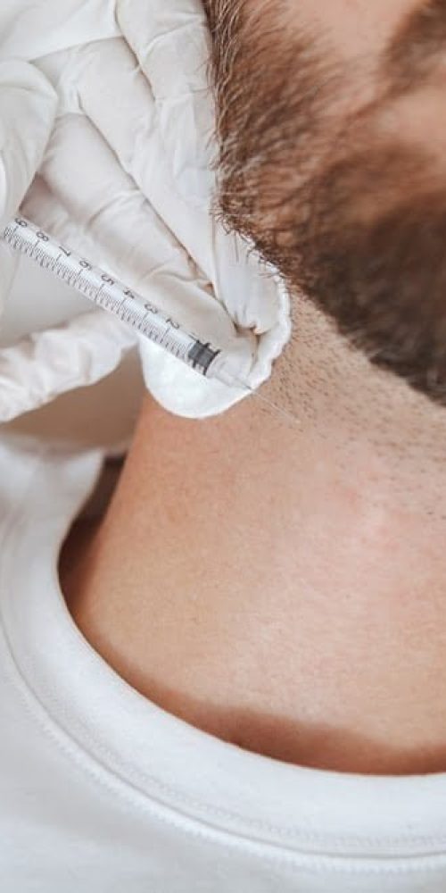 sakal-ekimi-yaptiranlar-wow-hair-clinic